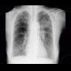 Lung carcinoma, carcinomatous lymphagiopathy, first radiograph: X-ray - Plain radiograph